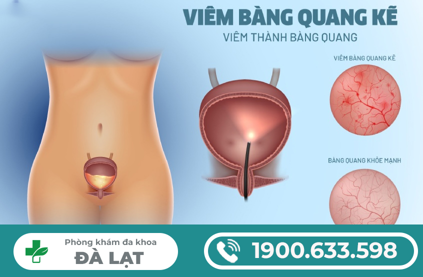 VIÊM BÀNG QUANG KẼ (MÃN TÍNH): Nguyên nhân, Dấu hiệu, Biến chứng, Điều trị