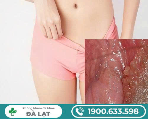  Hạt đỏ -trắng nổi ở môi lớn và môi bé vùng kín?  Nguyên nhân, dấu hiệu và những điều cần chú ý