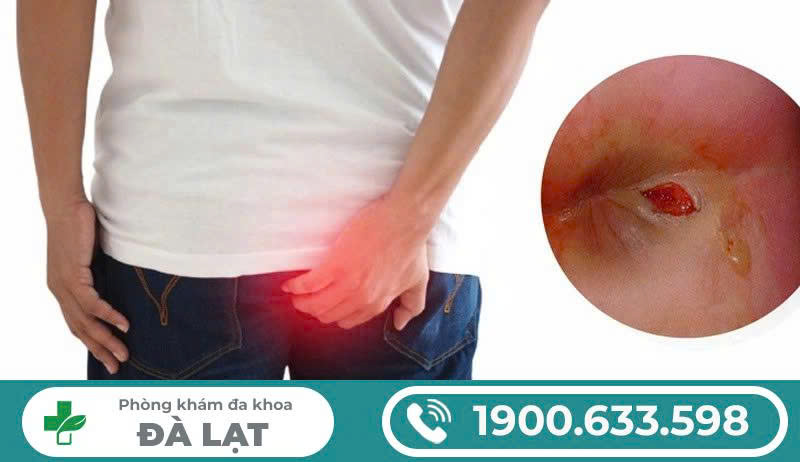 Nguyên nhân, dấu hiệu nhận biết và biến chứng khi nổi hạch Dương vật