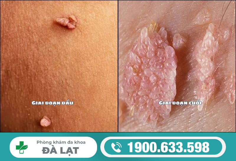 SÙI MÀO GÀ Ở VÙNG KÍN: ĐIỀU TRỊ NHƯ THẾ NÀO CHO ĐÚNG CÁCH?