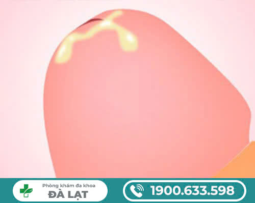 Đi tiểu ra dịch màu trắng ở nam giới 