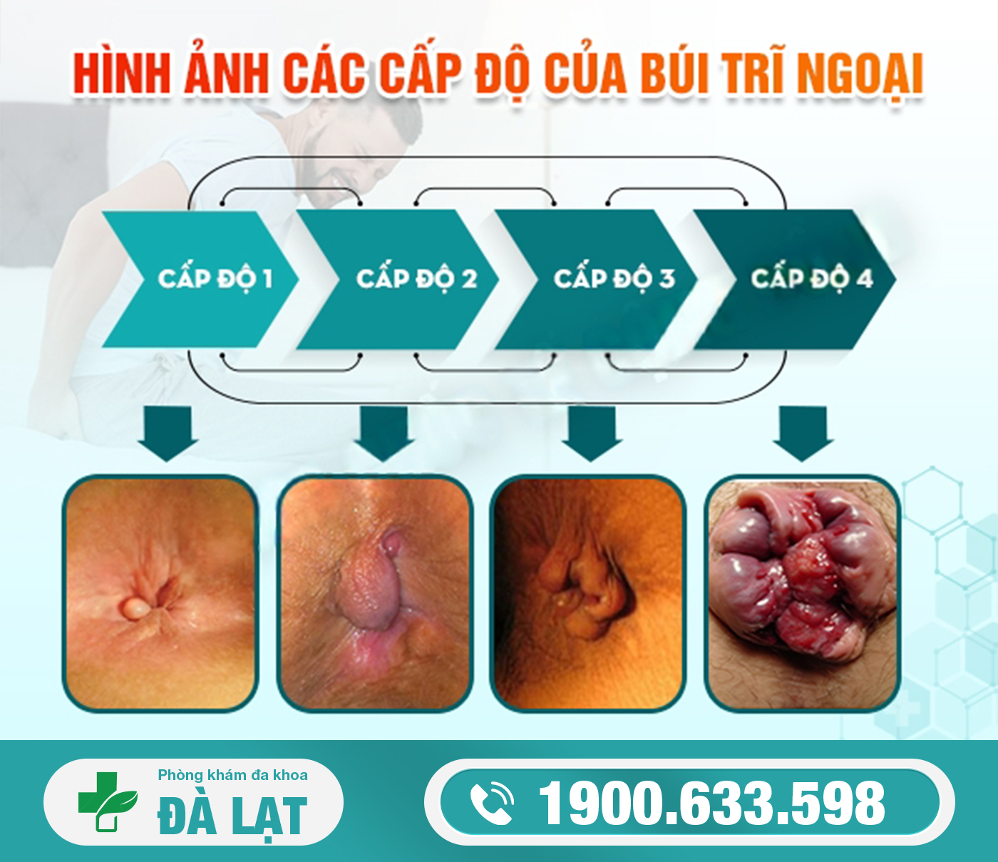 GIAI ĐOẠN 1,2,3,4 CỦA BỆNH TRĨ NGOẠI    