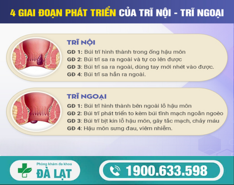 BỆNH TRĨ CÁC CẤP ĐỘ 1,2,3,4   