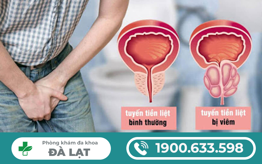 CÁCH CHỮA VIÊM TUYẾN TIỀN LIỆT