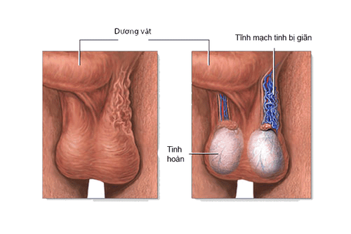 ĐAU TINH HOÀN CÓ NGUY HIỂM KHÔNG? - PHƯƠNG PHAP ĐIỀU TRỊ HIỆU QUẢ NHẤT!