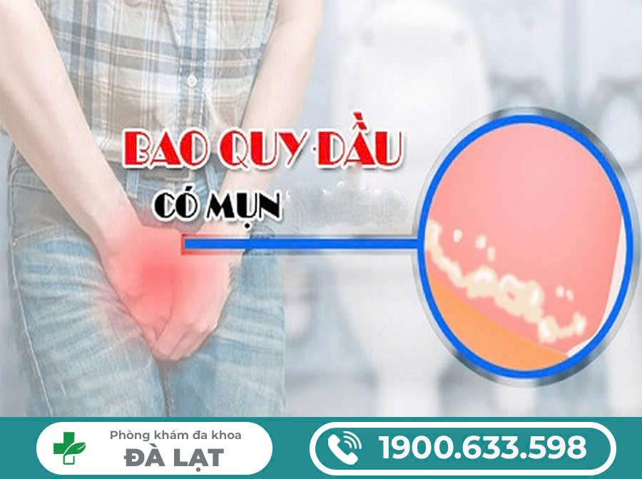 Mụn ở bao quy đầu: Nguyên nhân, biểu hiện và điều trị như thế nào?