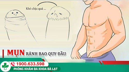 Mụn ở rãnh bao quy đầu có bị sao không? Phương pháp điều trị