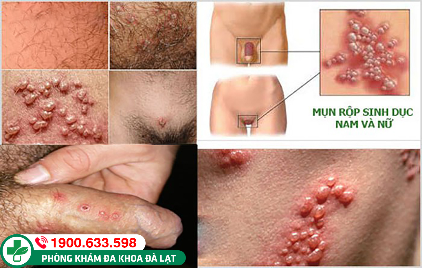 Mụn nước sinh dục ở nam và nữ giới