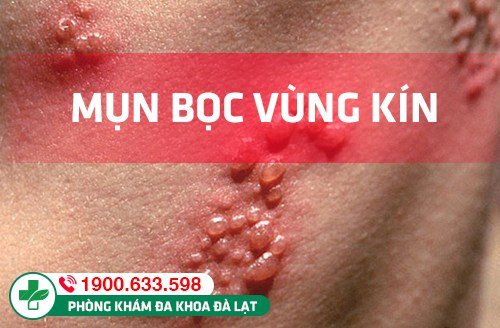 Nguyên nhân, cách điều trị mụn bọc sinh dục ở nam và nữ giới