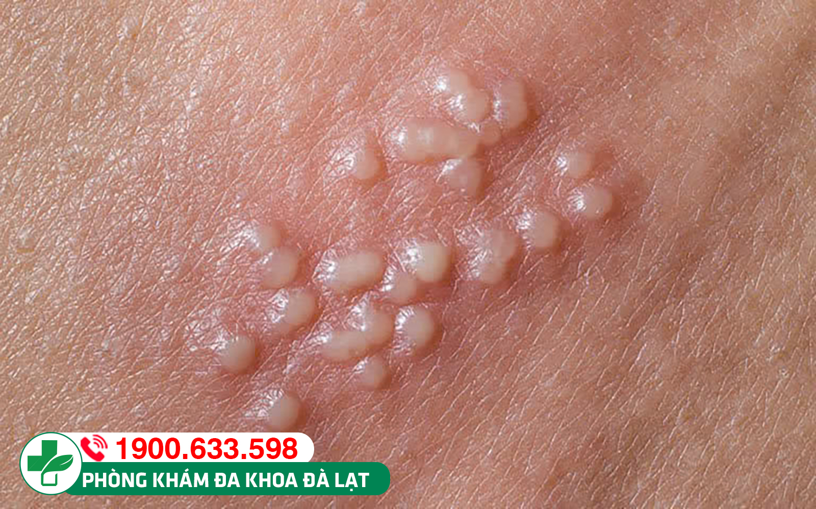 Nổi mụn trắng sinh dục: lời cảnh báo sức khỏe