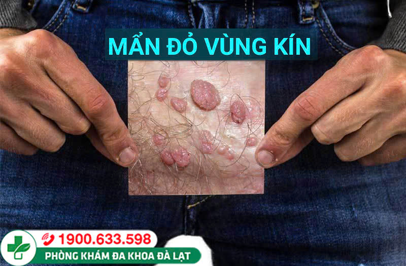MỤN ĐỎ SINH DỤC NAM CÓ NGUYÊN NHÂN DO ĐÂU VÀ CÁCH KHẮC PHỤC