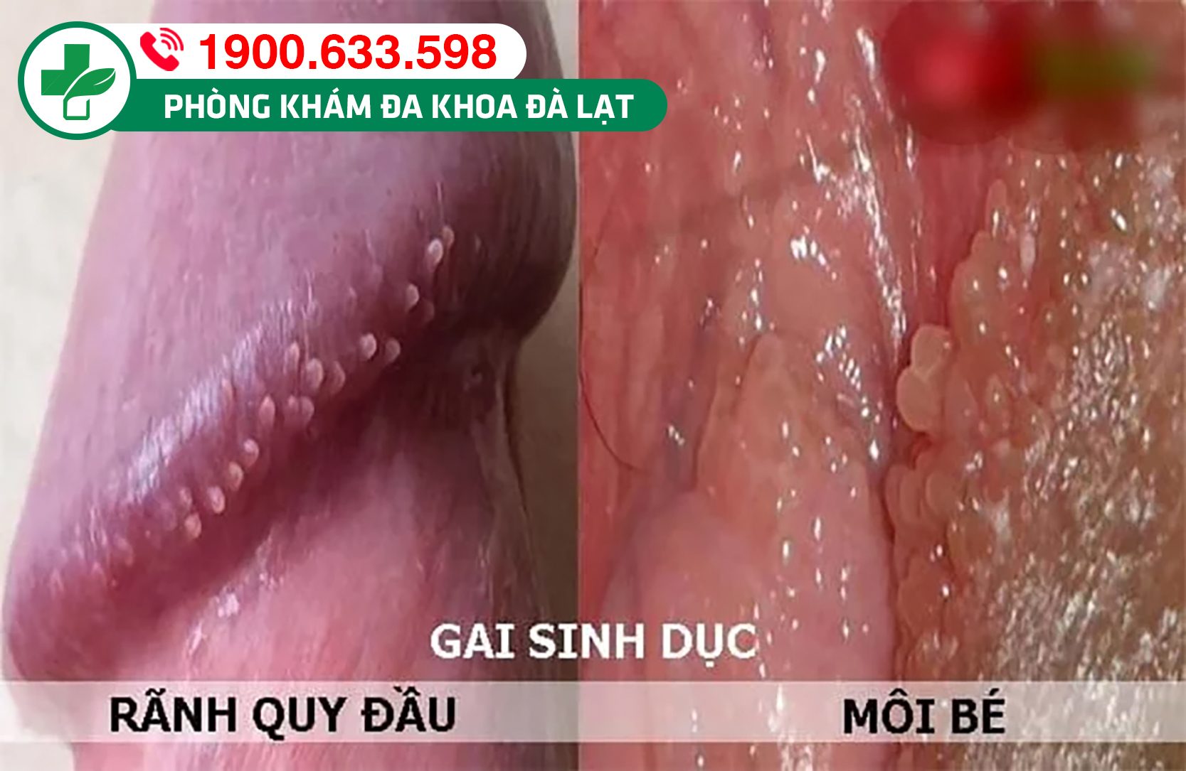 Tìm hiểu về bệnh gai sinh dục, nguyên nhân và cách điều trị