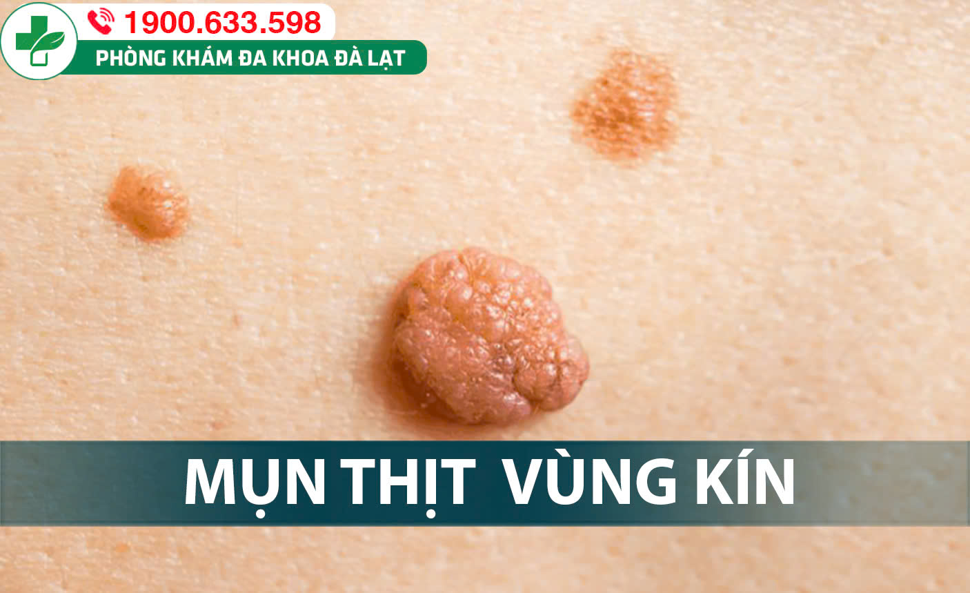GÓC GIẢI ĐÁP: MỤN THỊT Ở BÌU TINH HOÀN