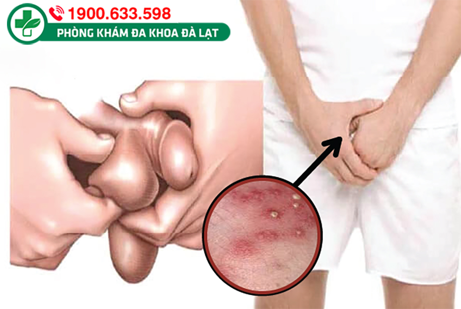 Bìu tinh hoàn nổi mụn là như thế nào?