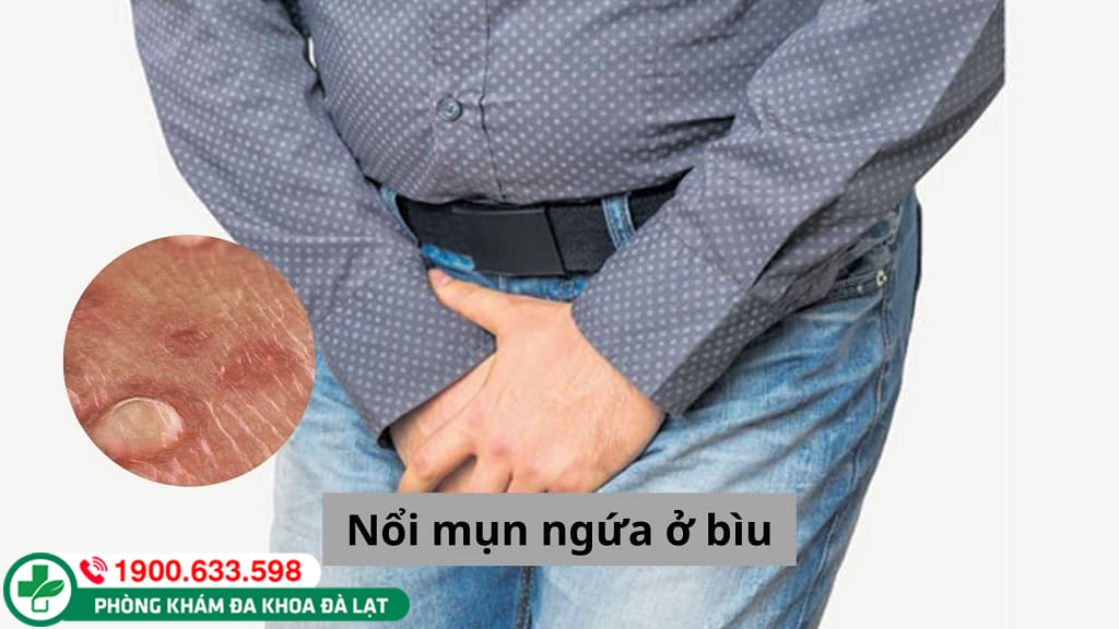 LÀM SAO ĐỂ KHẮC PHỤC TÌNH TRẠNG NỔI MỤN NGỨA VÙNG BÌU ?