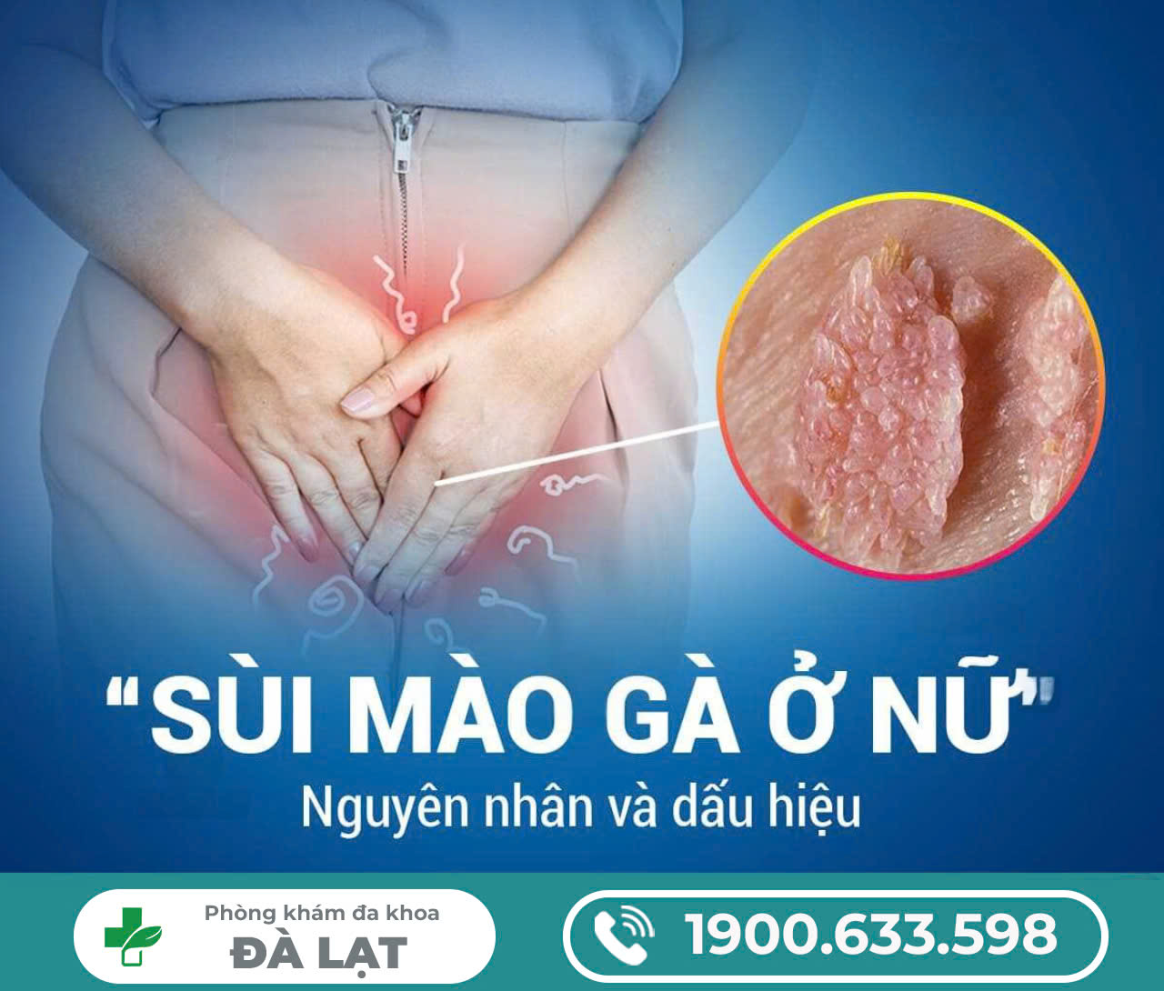 Sùi mào gà ở nữ giới: dấu hiệu nhận biết không thể bỏ qua và phương pháp điều trị