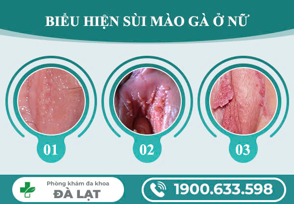 CÁCH CHỮA TRỊ BỆNH SÙI MÀO GÀ TẠI NỮ GIỚI