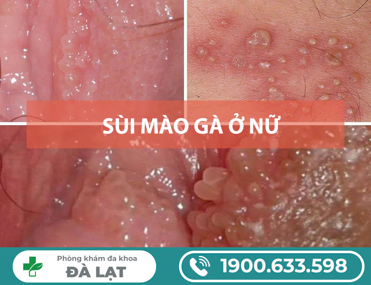 TÌM HIỂU CHUNG VỀ BỆNH SÙI MÀO GÀ Ở NỮ