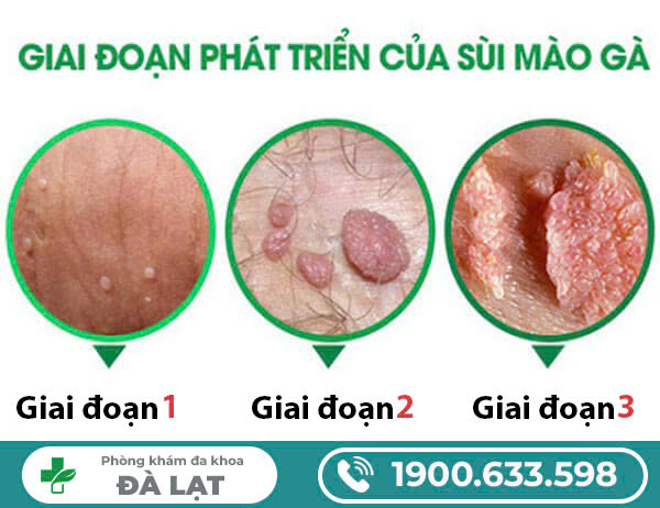 NGUYÊN NHÂN BỆNH SÙI MÀO GÀ Ở NỮ