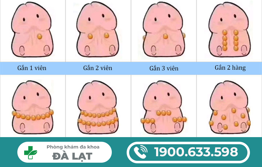 CÁCH GẮN BI DƯƠNG VẬT HIỆU QUẢ, AN TOÀN.