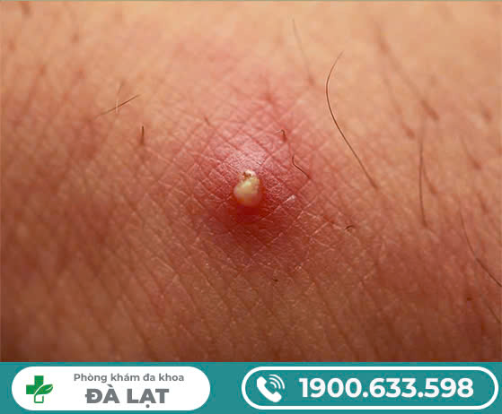 Nổi mụn trắng sinh dục: lời cảnh báo sức khỏe