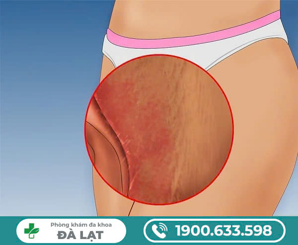 Nổi mụn ở mép vùng kín nữ: nguyên nhân phổ biến và cách trị