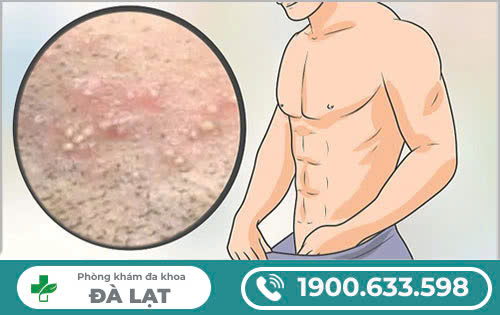 MỤN TRẮNG Ở VÙNG KÍN NAM