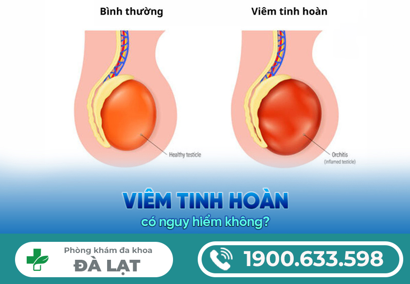 VIÊM TINH HOÀN: Nguyên nhân, Triệu chứng, Biến chứng nguy hiểm, Chi phí - cách điều trị, Nơi khám chữa uy tín
