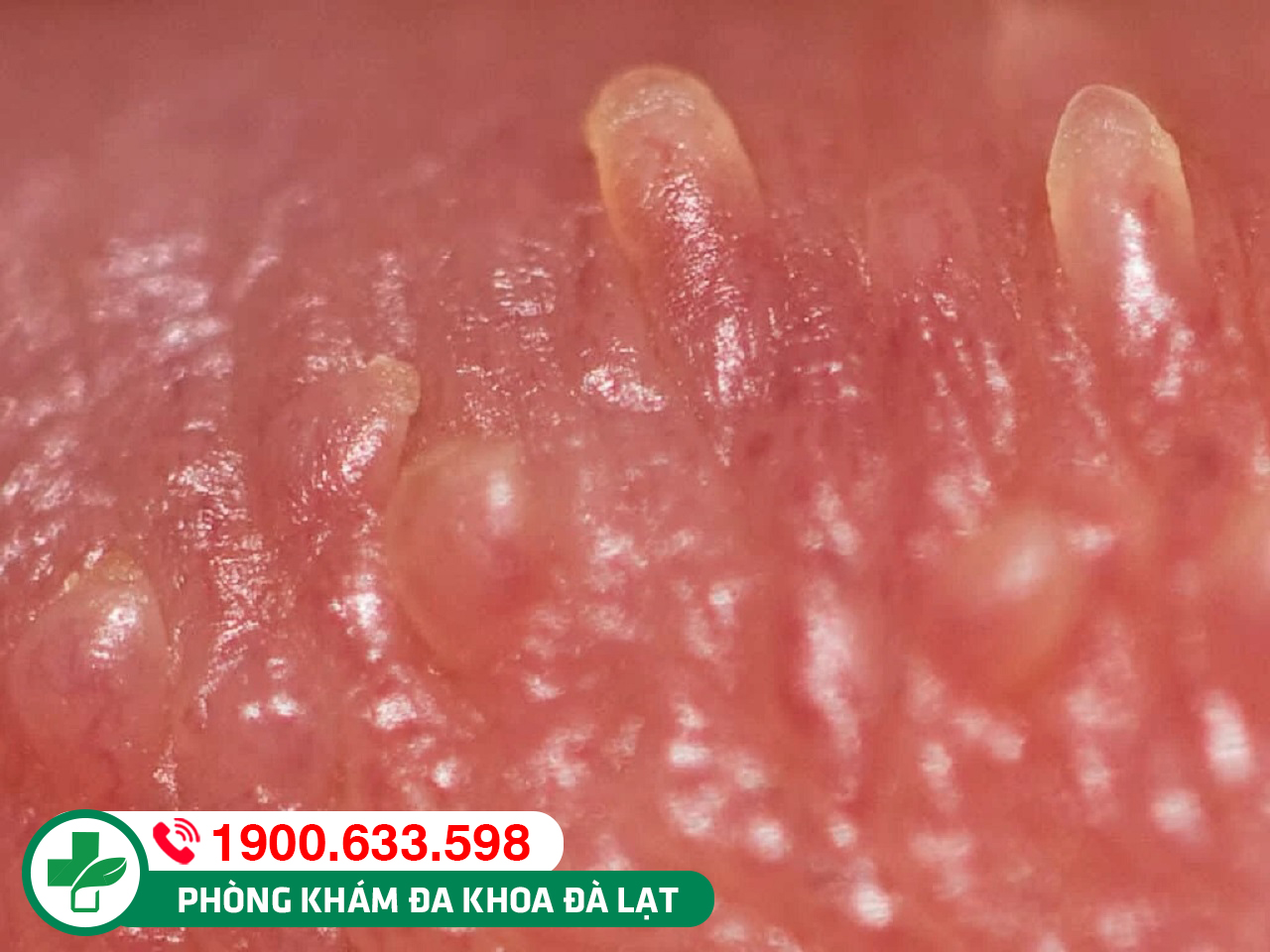 MỤN GAI SINH DỤC VÙNG KÍN