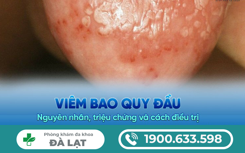 VIÊM BAO QUY ĐẦU : NGUYÊN NHÂN, DẤU HIỆU, CÁCH ĐIỀU TRỊ, ĐỊA CHỈ KHÁM CHỮA UY TÍN