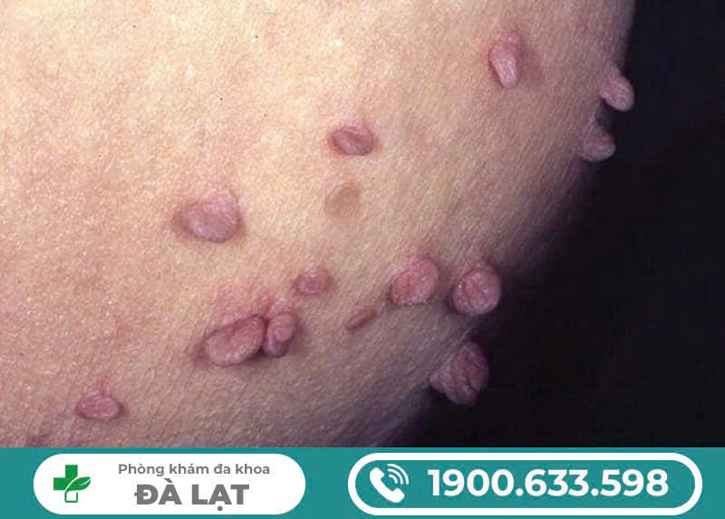 Cô bé nổi mụn cứng liệu có nguy hiểm.