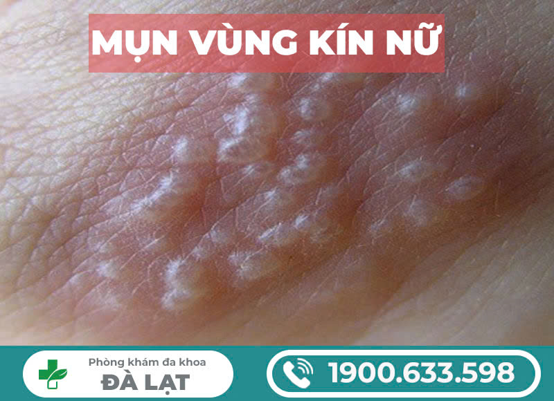 Mụn rộp tại vùng kín phụ nữ nguyên nhân, biểu hiện và cách chữa trị