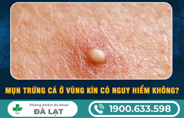 Mụn trứng cá ở vùng kín là dấu hiệu bệnh gì?