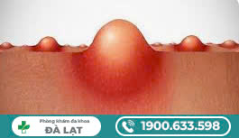 Vùng Kín Nổi Mụn Đỏ: Nguyên Nhân, Cách Điều Trị Và Phòng Ngừa Hiệu Quả