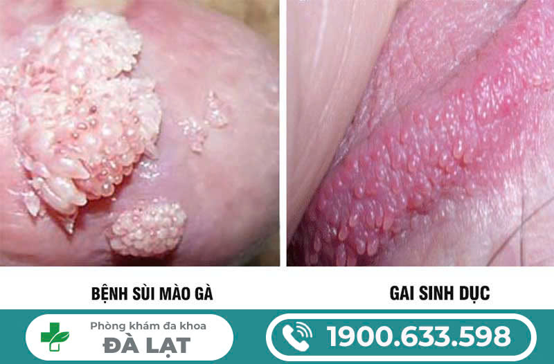 Mọc mụn ở môi bé: Nguyên nhân, triệu chứng và cách điều trị hiệu quả