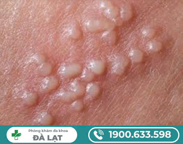 Nổi Mụn Nước Ở Môi Lớn: Nguyên Nhân, Triệu Chứng Và Cách Điều Trị Hiệu Quả