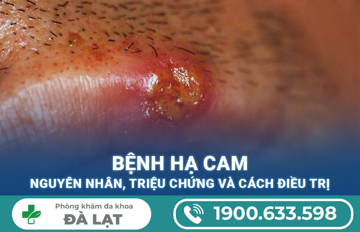 Hạ cam: Nguyên nhân, biểu hiện, cách điều trị 