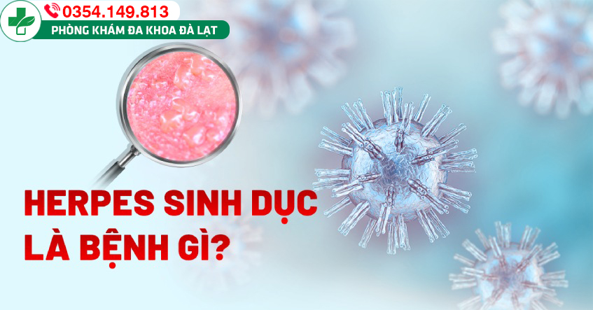 Bệnh Herpes sinh dục: Nguyên nhân, triệu chứng và cách điều trị