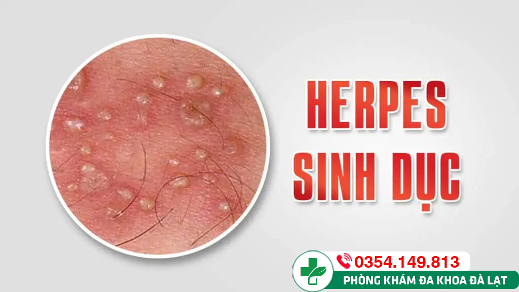Herpes âm đạo ở nữ giới: Nguy hiểm tiềm ẩn và cách nhận biết