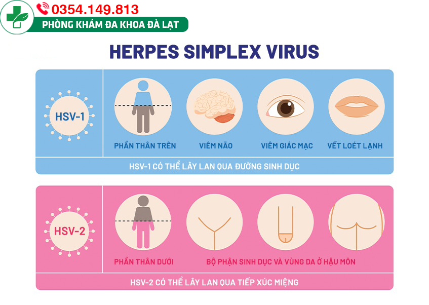 Herpes nữ giới có nguy hiểm không? Cách điều trị như thế nào?