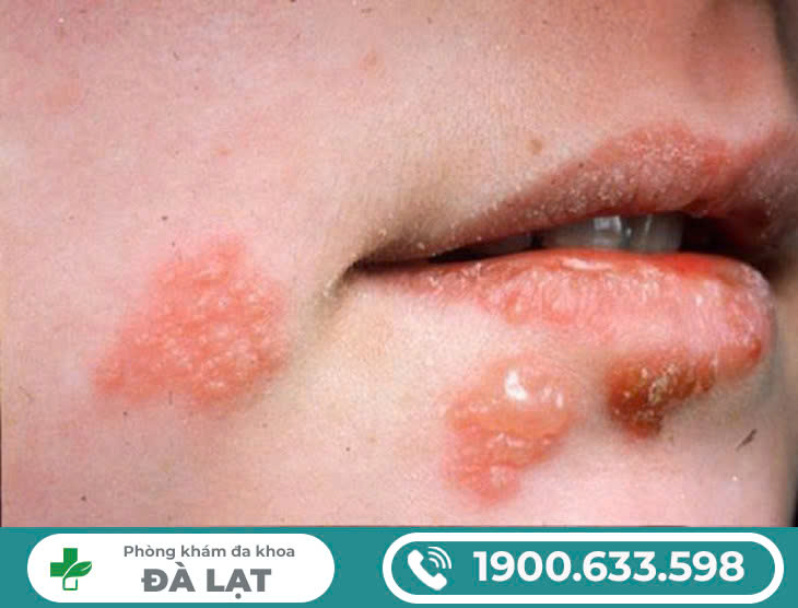 Các bệnh tình dục ở miệng: Triệu chứng và cách điều trị