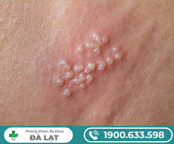 Virus HPV là gì, lây truyền như thế nào?