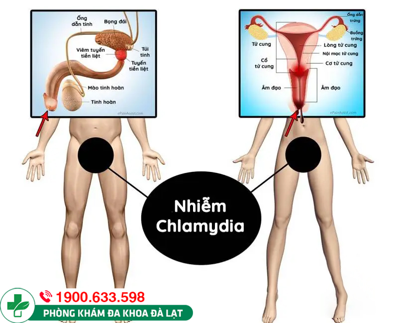 Tìm hiểu bệnh Chlamydia ở nữ giới là gì?