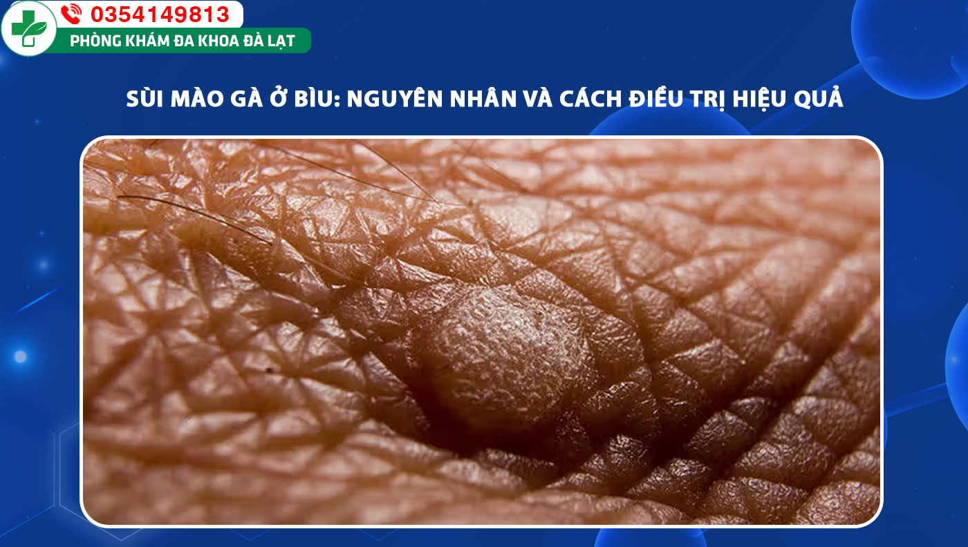 Sùi mào gà ở bìu: Nguyên nhân và cách điều trị hiệu quả