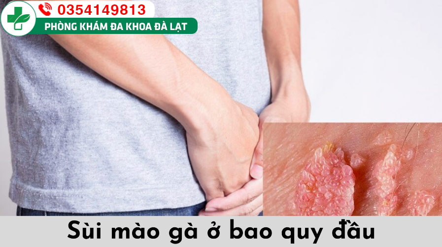 Sùi mào gà ở bao quy đầu: nỗi lo “thầm kín” của nam giới
