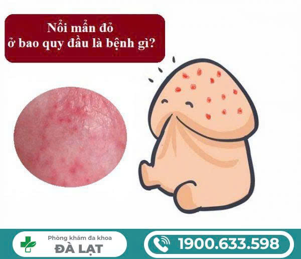 Dương Vật Nổi Mẩn Đỏ Nhưng Không Ngứa: Nguyên Nhân, Dấu Hiệu Nhận Biết Và Cách Xử Lý Hiệu Quả