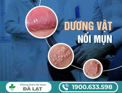 QUAN HỆ XONG NỔI MỤN CÓ NGUY HIỂM KHÔNG? NGUYÊN NHÂN, TRIỆU CHỨNG VÀ PHƯƠNG PHÁP ĐIỀU TRỊ HIỆU QUẢ