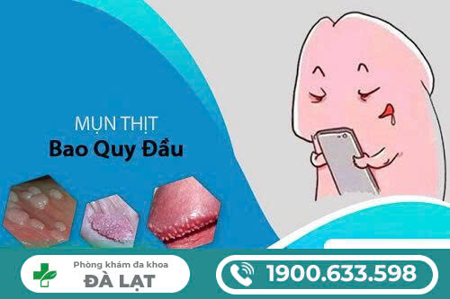 MỌC MỤN THỊT Ở BAO ĐẦU QUY, NGUYÊN NHÂN, TRIỆU CHỨNG VÀ PHƯƠNG PHÁP ĐIỀU TRỊ HIỆU QUẢ