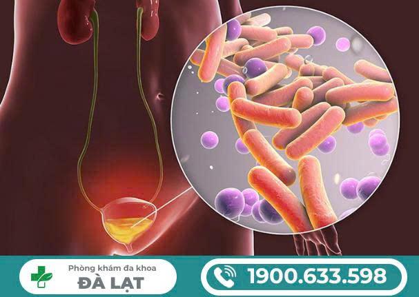 ĐAU VÌ VIÊM ĐƯỜNG TIẾT NIỆU - CÓ NGUY HIỂM KHÔNG?