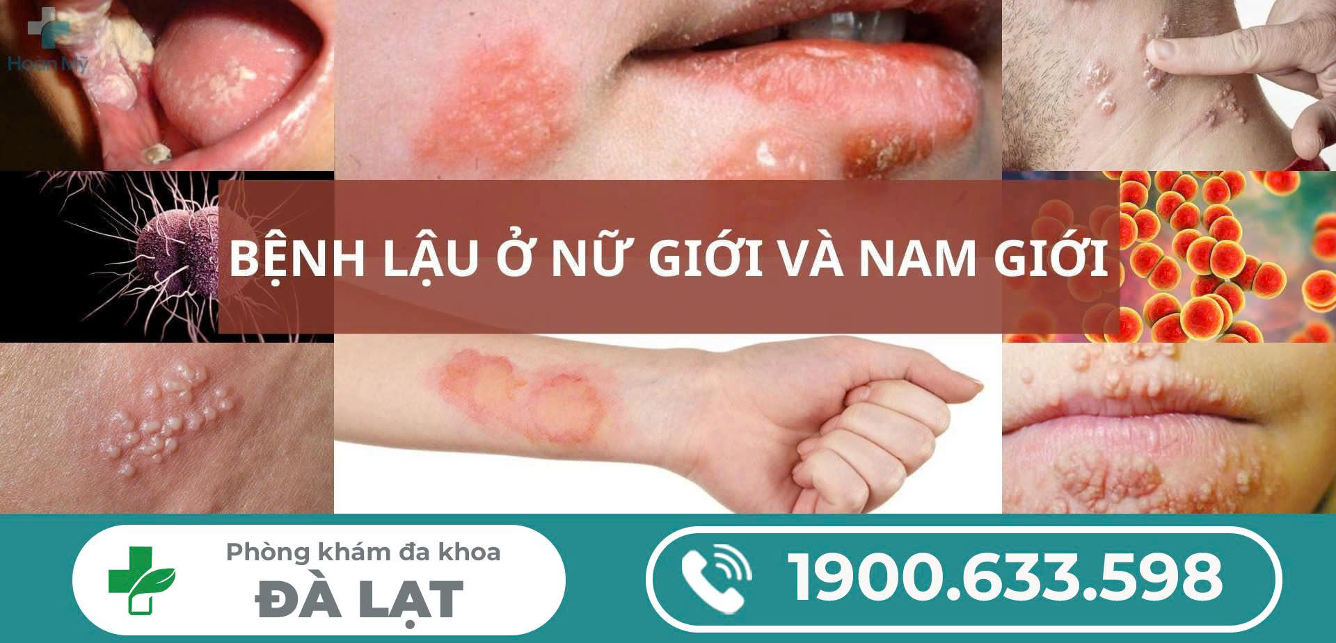 TÌM HIỂU: BỆNH LẬU CHẢY MỦ – BẠN BIẾT GÌ?